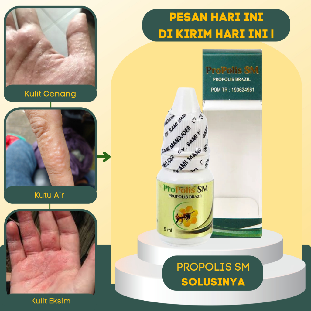 Obat oles kulit jari tangan kering pecah pecah bersisik menebal mengelupas gatal berair, Obat gatal 