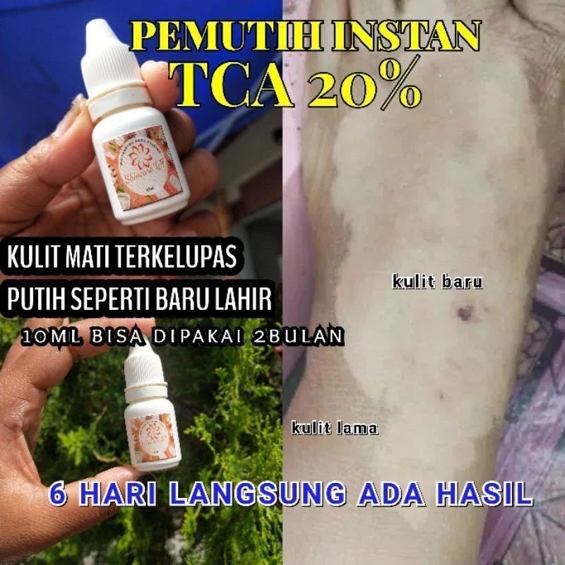 PEELING TCA EKSFOLIASI 20 %. KUSUS KULIT HITAM DAKI LAKNAT