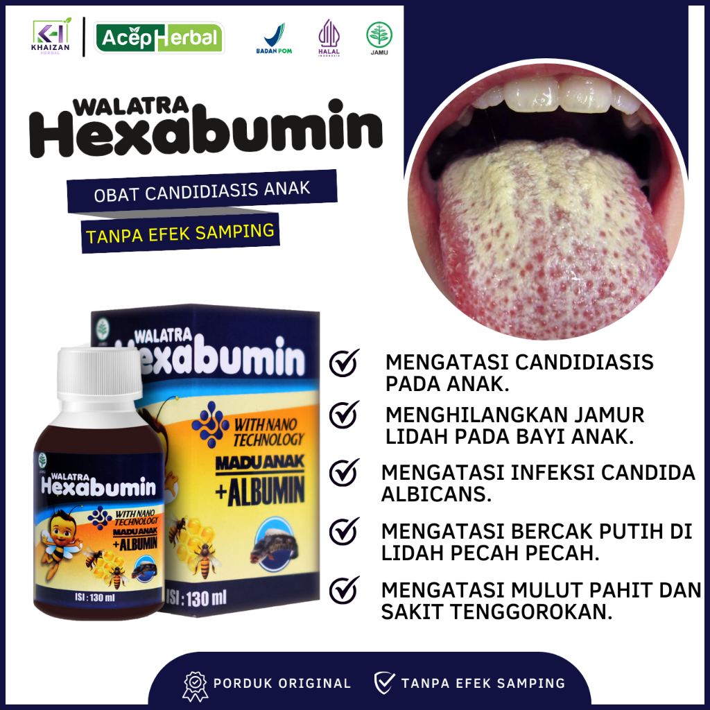 HEXABUMIN Obat Candidiasis Lidah Obat  Menghilangkan Jamur Lidah Pada Bayi Anak Untuk Mengatasi Infe
