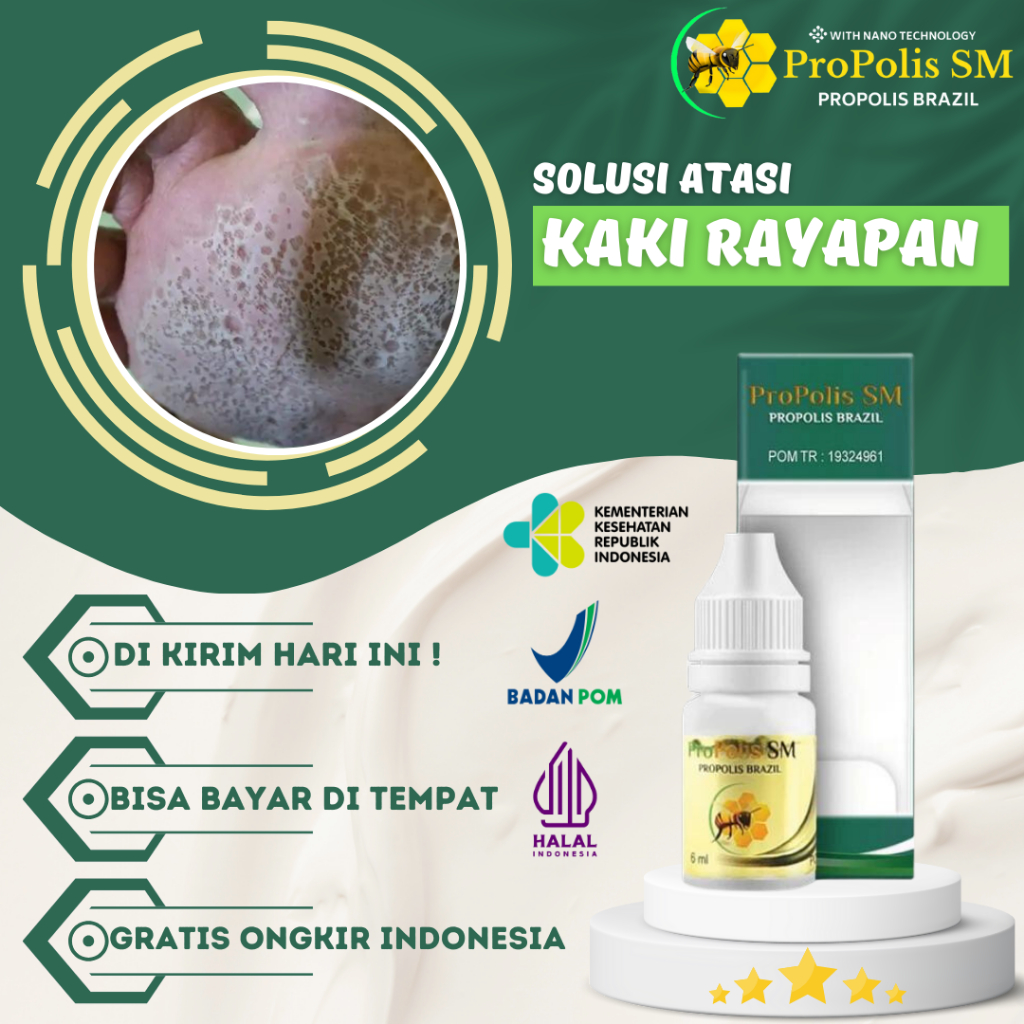 Obat Kaki Rayapan, Bolong-bolong, Rorombeheun, Obat Kaki Rayapan Kutu Air Telapak Kaki Bolong-Bolong