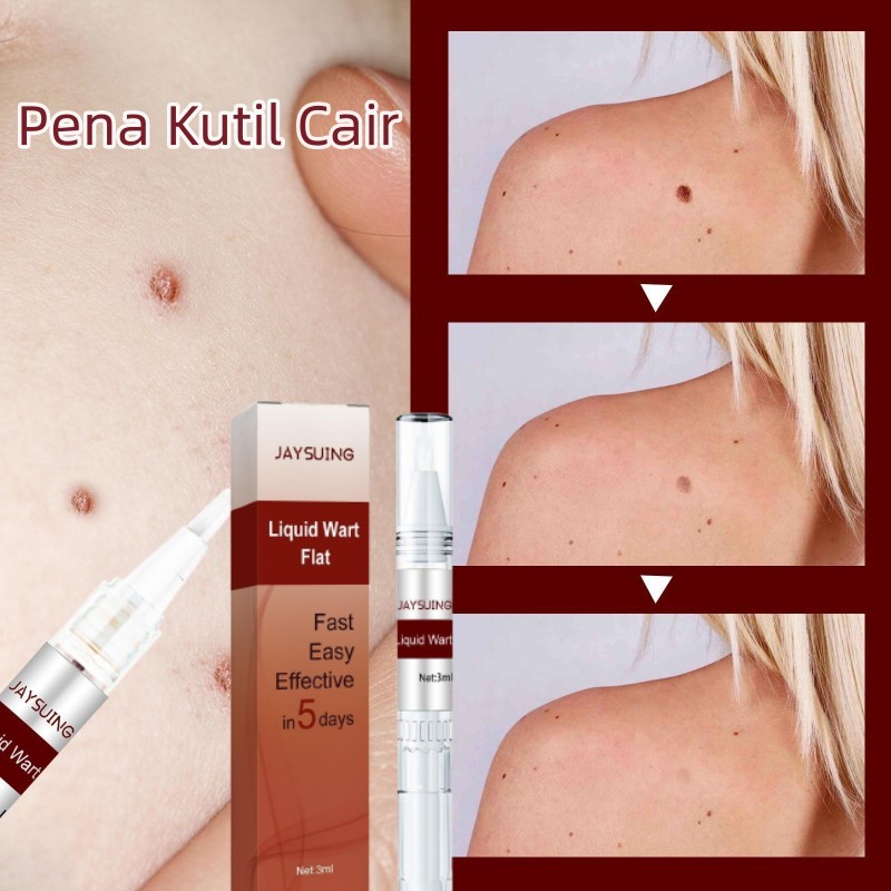 Penghilang kutil wart remover pen Penghilang Tahi Lalat Penghilang Kutil Skin Tag Remover Menghilangkan Tahi Lalat