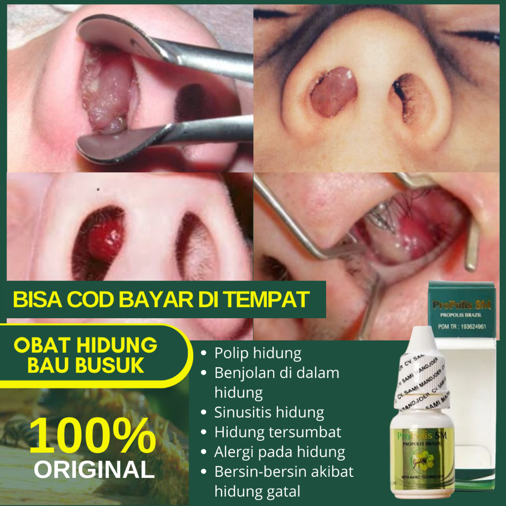 Obat Hidung Bau Busuk, Obat Ingus Bau Busuk, Obat Sinusitis Akut / Kronis, Hidung Tersumbat, Bau Mul