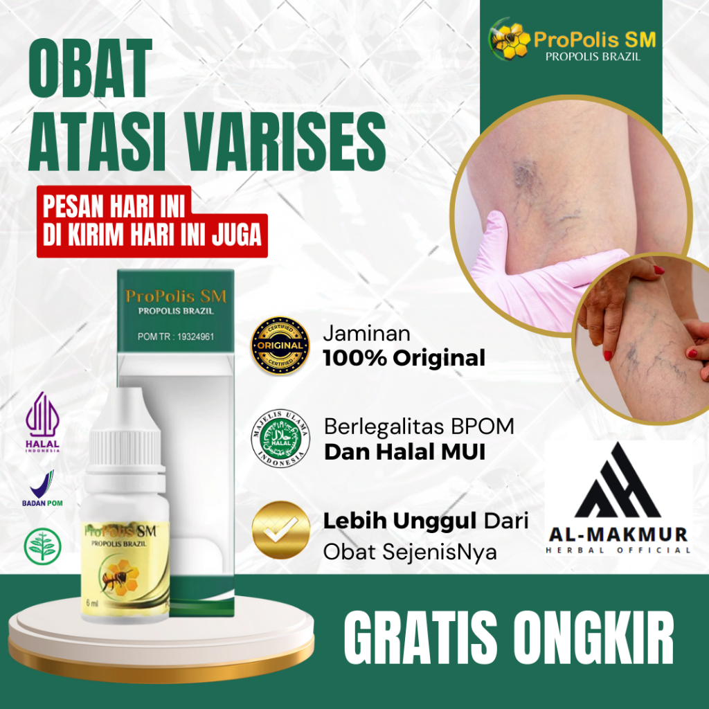 Obat Varises, Obat Penghilang Varises, Obat Urat Menonjol, Obat Urat Menggumpal, Obat Varises Di Pah