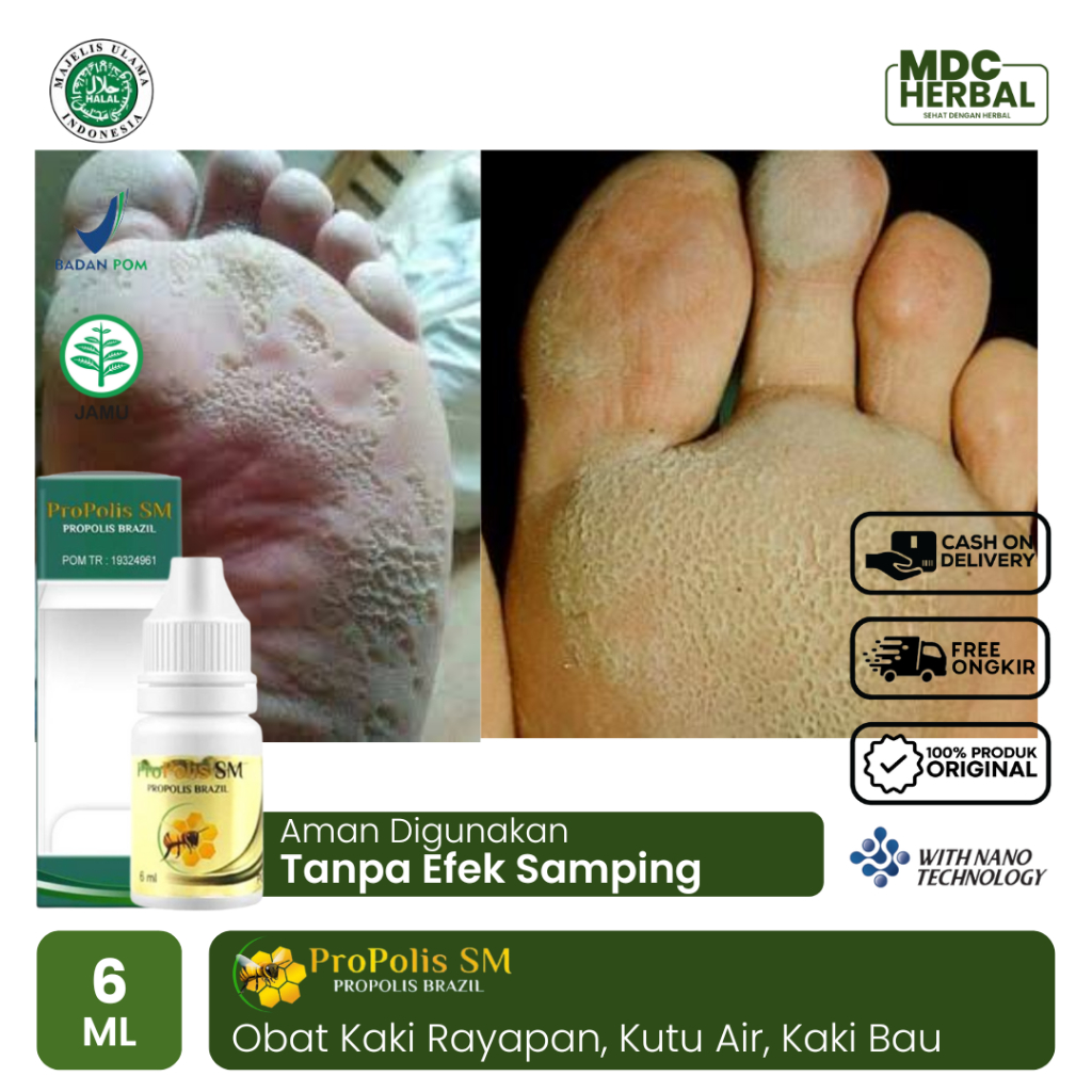Obat Kaki Rayapan Telapak Kaki Bolong Bolong dan Bau Karena Kutu Air Kaki Pecah Pecah - Propolis SM