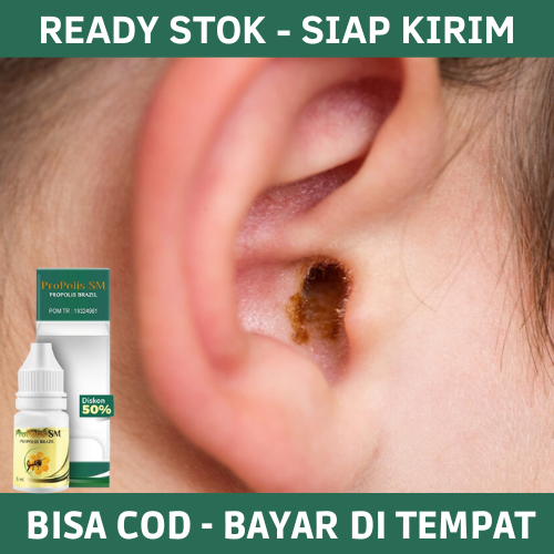 Obat Tetes Kotoran Telinga Keras, Obat Pelunak Pencair Kotoran Telinga, Obat Tetes Kuping Untuk Anak