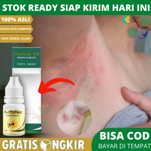 Obat Gatal Ruam Iritasi Di Ketiak, Obat Lipatan Ketiak Hitam Dan Gatal, Obat Gtal Bruntusan Di Ketia