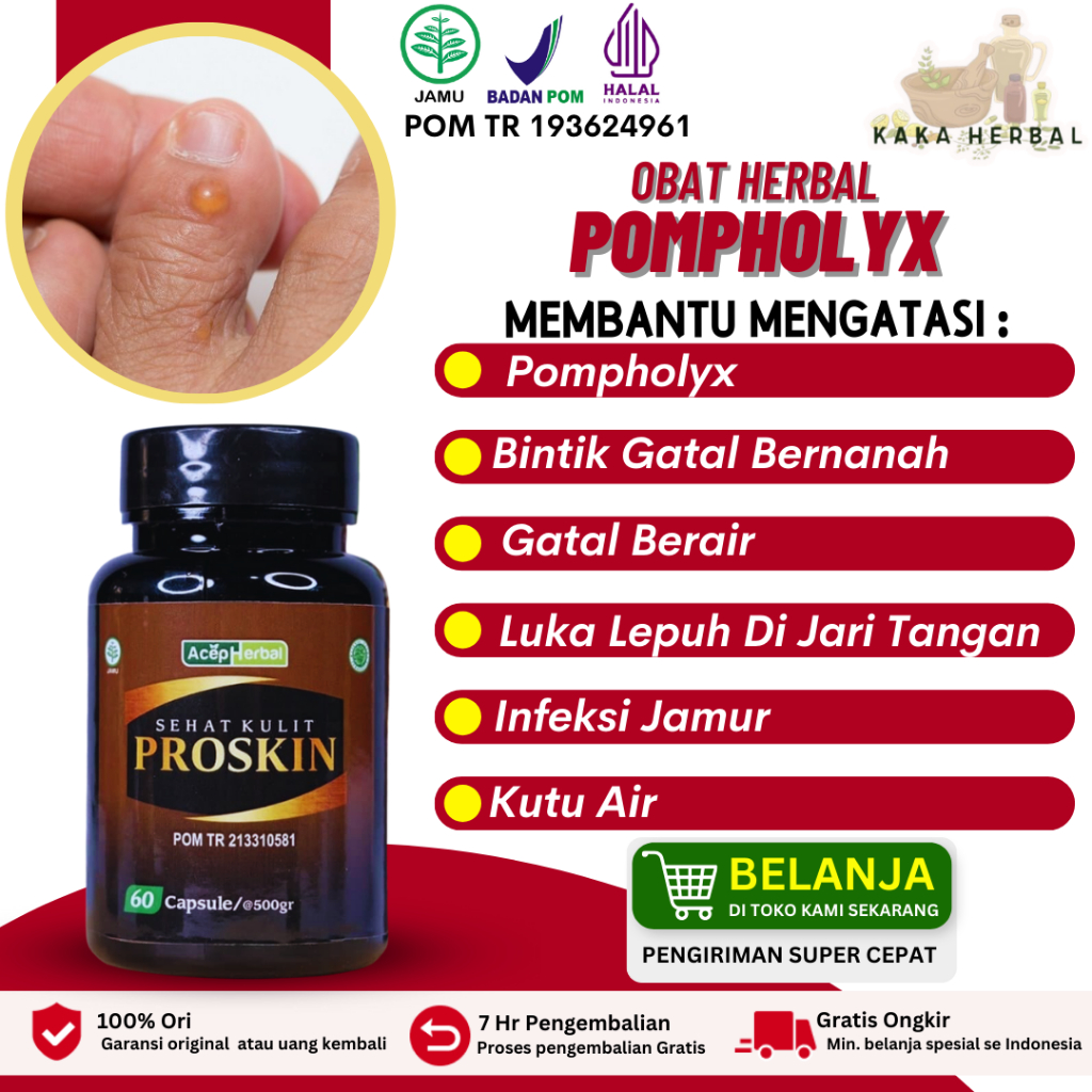 Kaka Herbal - Obat pompholyx Di Tangan, Obat Eksim Dishidrotik, Obat Bintik Berair Di Jari Tangan, O