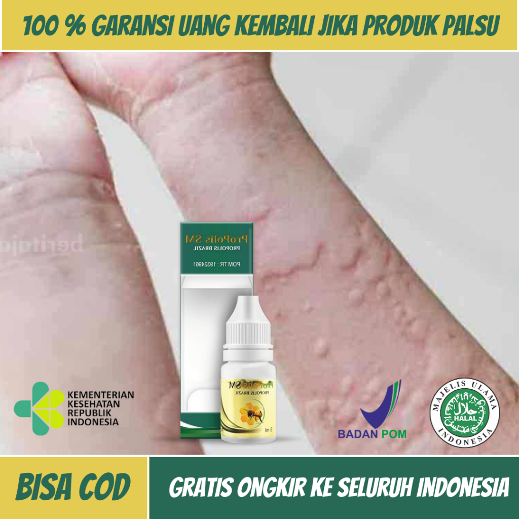 Obat Biduran, Obat Kulit Gatal Kemerahan, Obat Gatal-Gatal Di Seluruh Badan, Obat Gatal Bentol-Bento