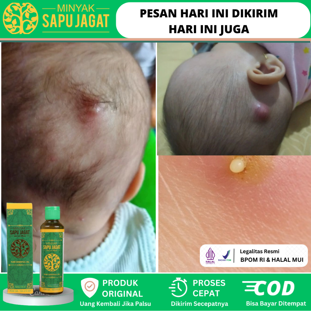 Minyak Oles Untuk Bisul, Obat Bisul Di Kepala, Obat Bisul Bernanah Di Kelamin, Obat Bisul Di Ketiak,