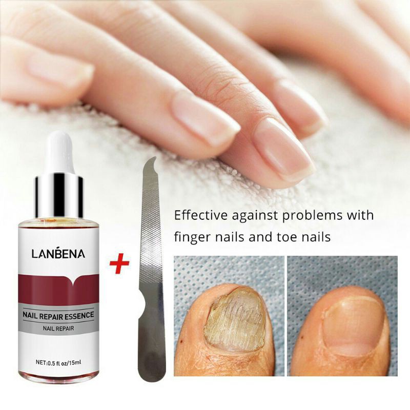 Promo Obat jamur kuku Lanbena serum perawatan kuku
