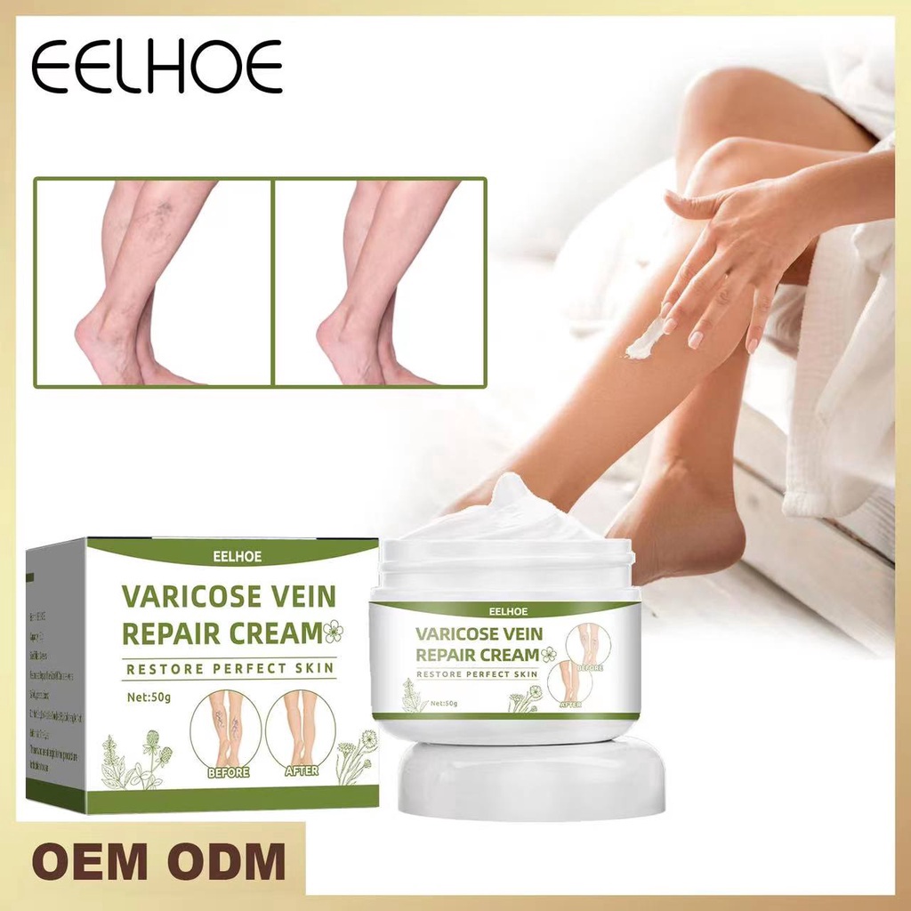 Ready¡Eelhoe Krim Permanen Varises Krim Varises Vena Salep Flebitis Krim Kaki Varises Vena Pereda Ny