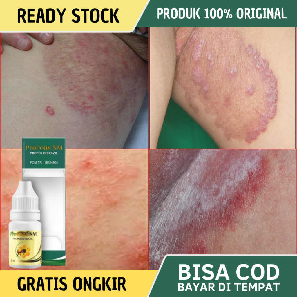 Obat Gatal Selangkangan, Obat Selangkangan Merah Gatal, Obat Selangkangan Bersisik, Obat Selangkanga