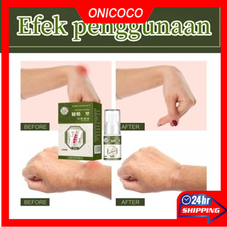 Tenosynovitis Heel Pain Spray Pain Relief Spray Cold Compress Gel Nyeri Sendi Pergelangan Tangan
