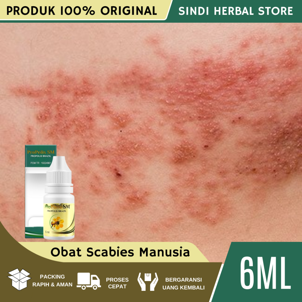 Obat Scabies Manusia, Obat Gatal Scabies Manusia, Obat Gatal Scabies, Obat Gatal Scabies Alami, Obat