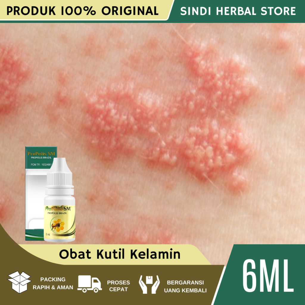 Obat Kutil Kelamin, Perontok Kutil Kelamin Alami, Penghilang Kutil Kelamin, Penghancur Kutil Kelamin