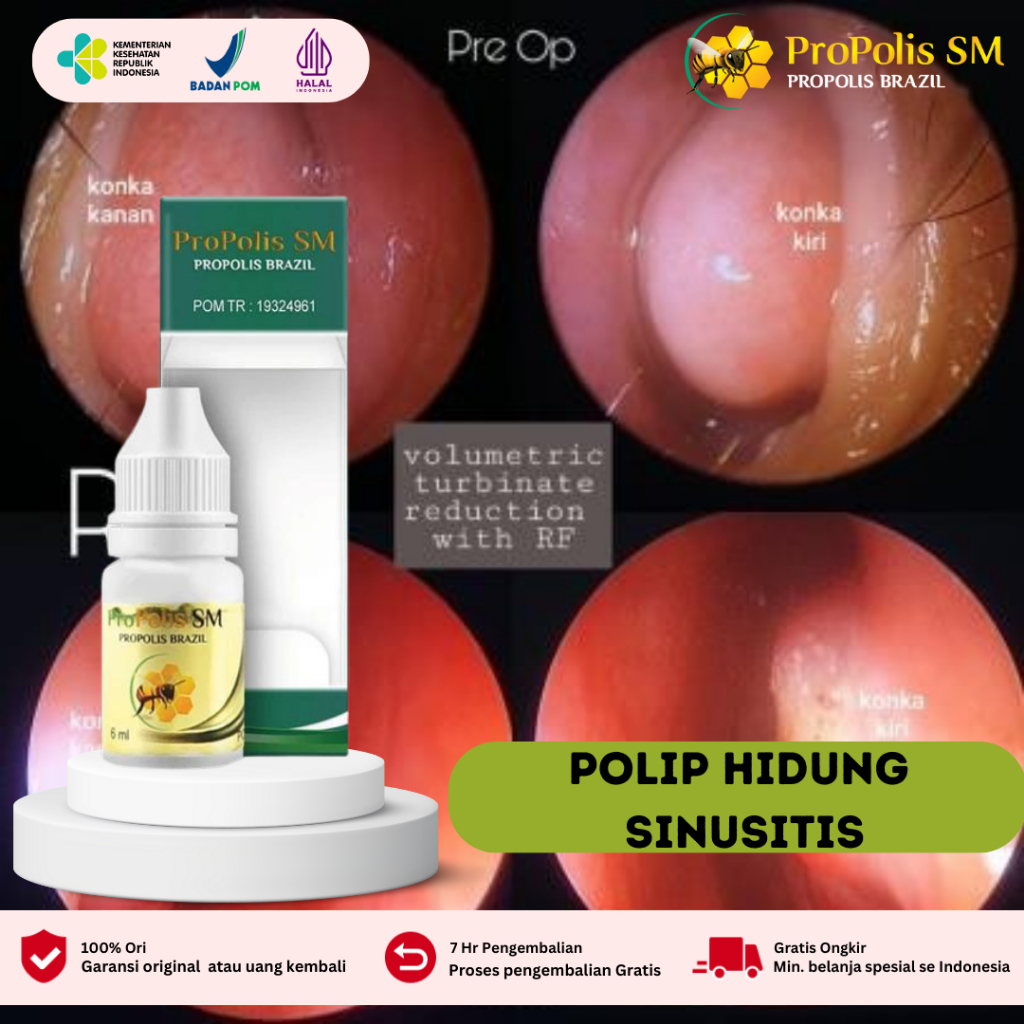 Obat Polip Hidung Anak Dewasa, Obat Sinusitis, Obat Pilek Menahun, Obat Hidung Tersumbat Benjolan di