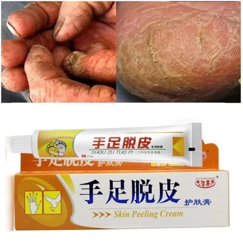 SALEP HUATUO KULIT KERING PECAH PECAH KAPALAN Shou zu tuo pi skin peeling cream Melembabkan kulit ke