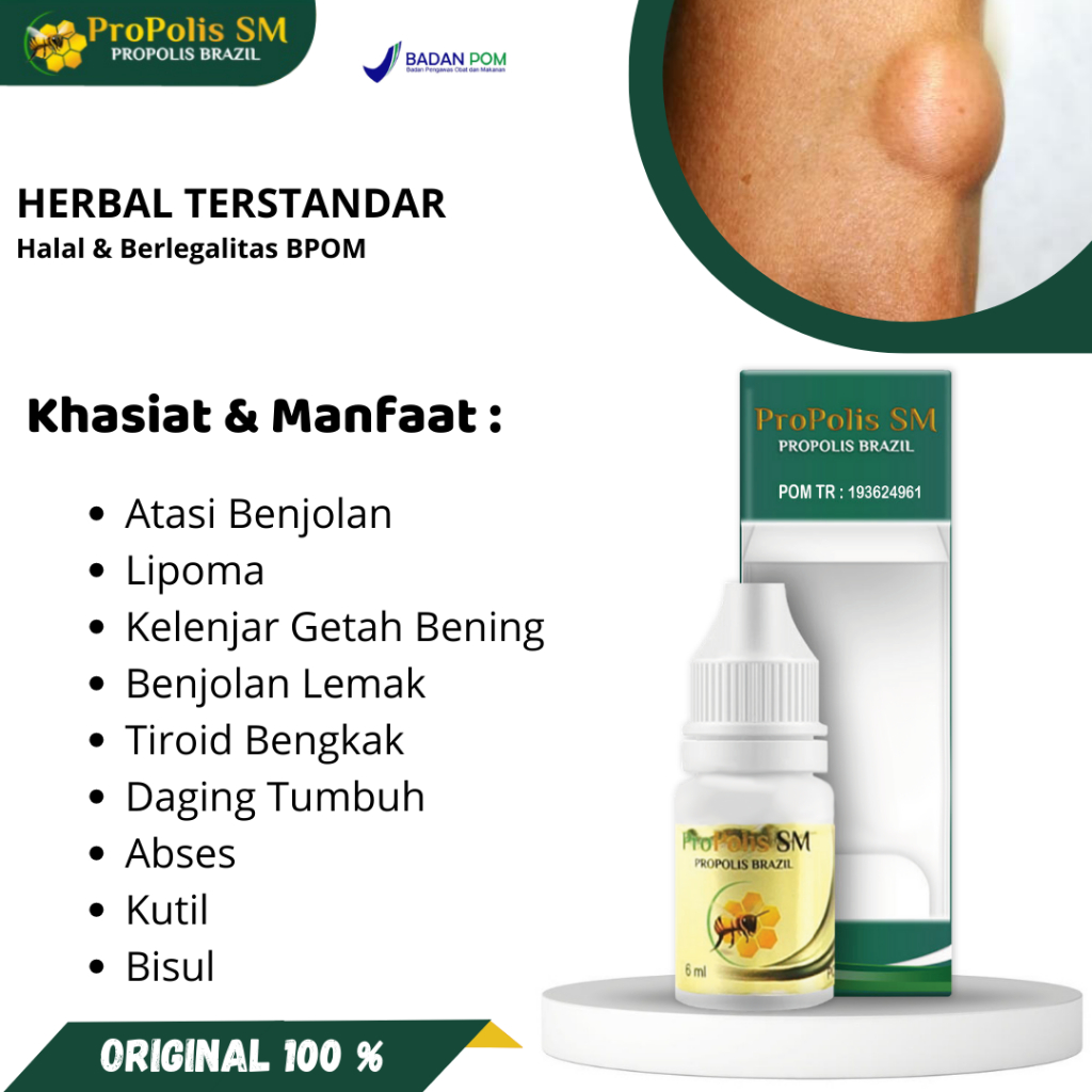 Obat Oles Benjolan, Lipoma, Kelenjar Getah Bening, Benjolan Lemak, Tiroid Bengkak, Daging Tumbuh, Ab