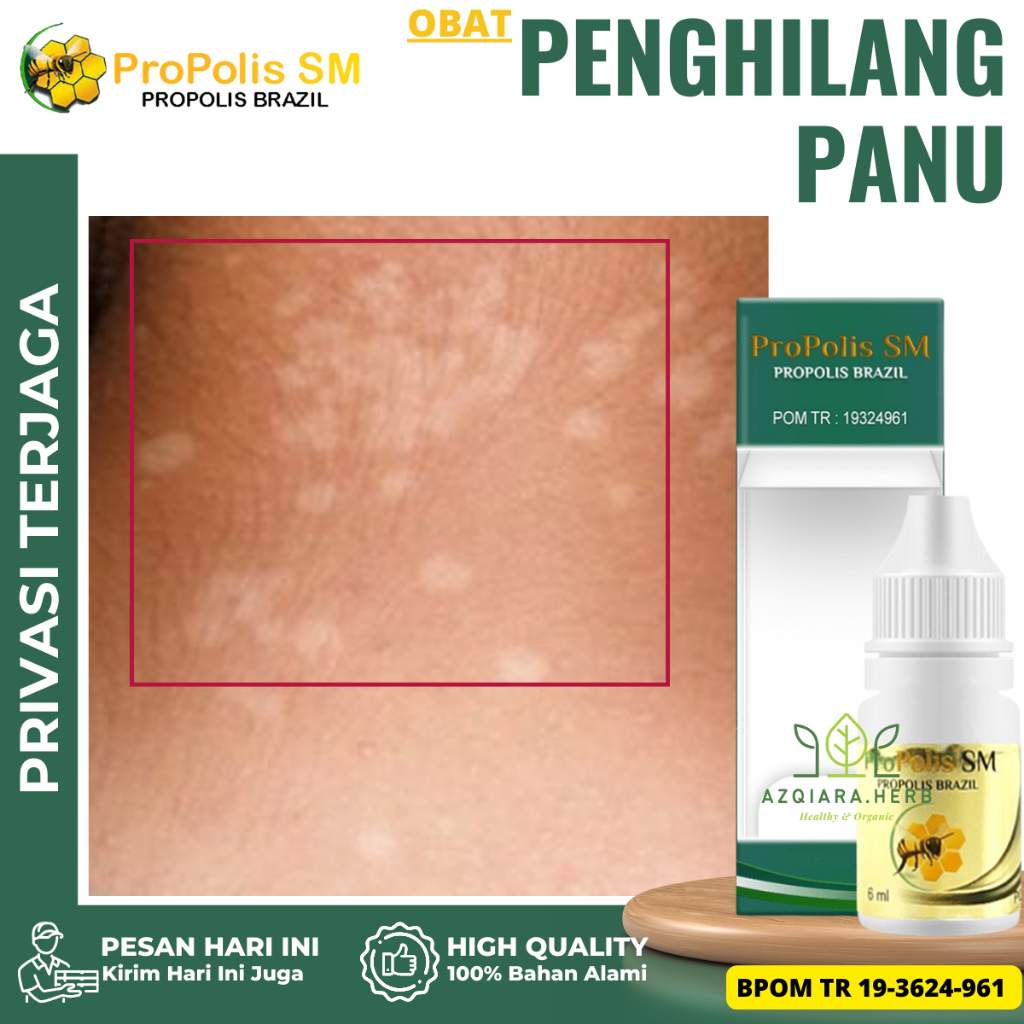 Obat Penghilang Panu, Obat Bercak Putih, Salep Penghilang Panu Di Seluruh Tubuh, Obat Kulit Hapuran,
