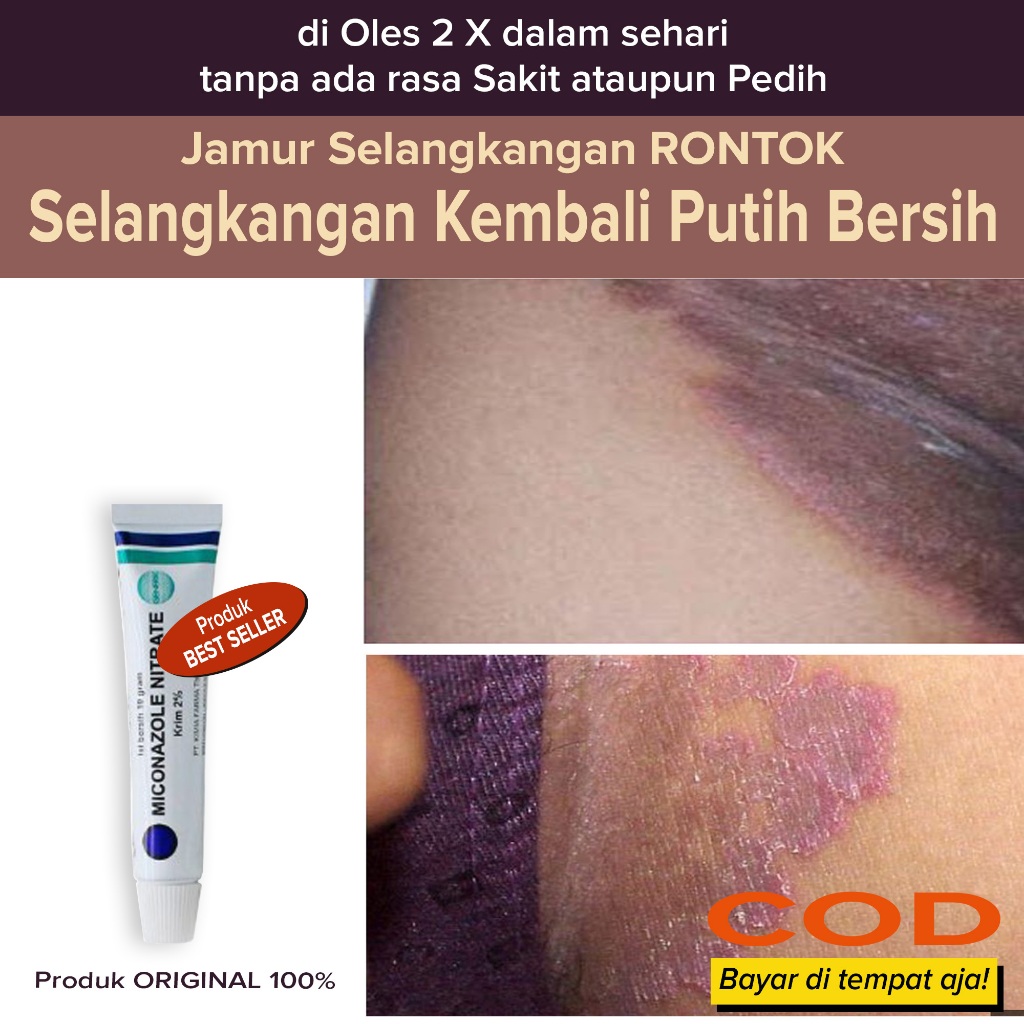Salep Obat Anti jamur gatal selangkangan Membersihkan jamur Penyebab Selangkangan Gelap Menghitam da