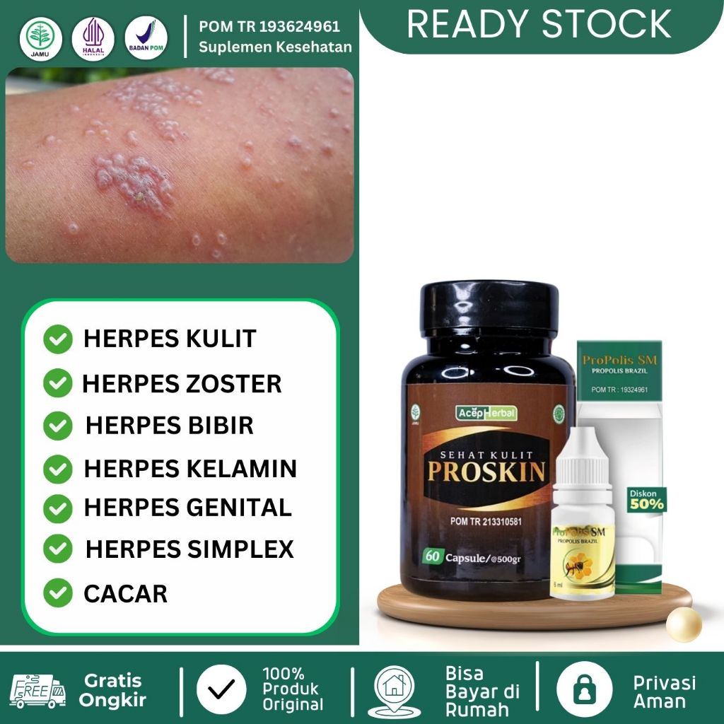 Obat Herpes Zoster, Herpes Genital, Herpes Kelamin, Herpes Simplex, Herpes Bibir, Salep Herpes, Obat