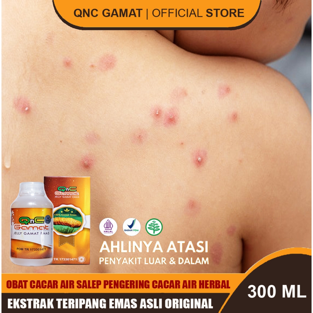 Obat Herbal Cacar Air Agar Cepat Kering  Obat Cacar Air Pada Anak Paling Ampuh Qnc Gamat Teripang Em