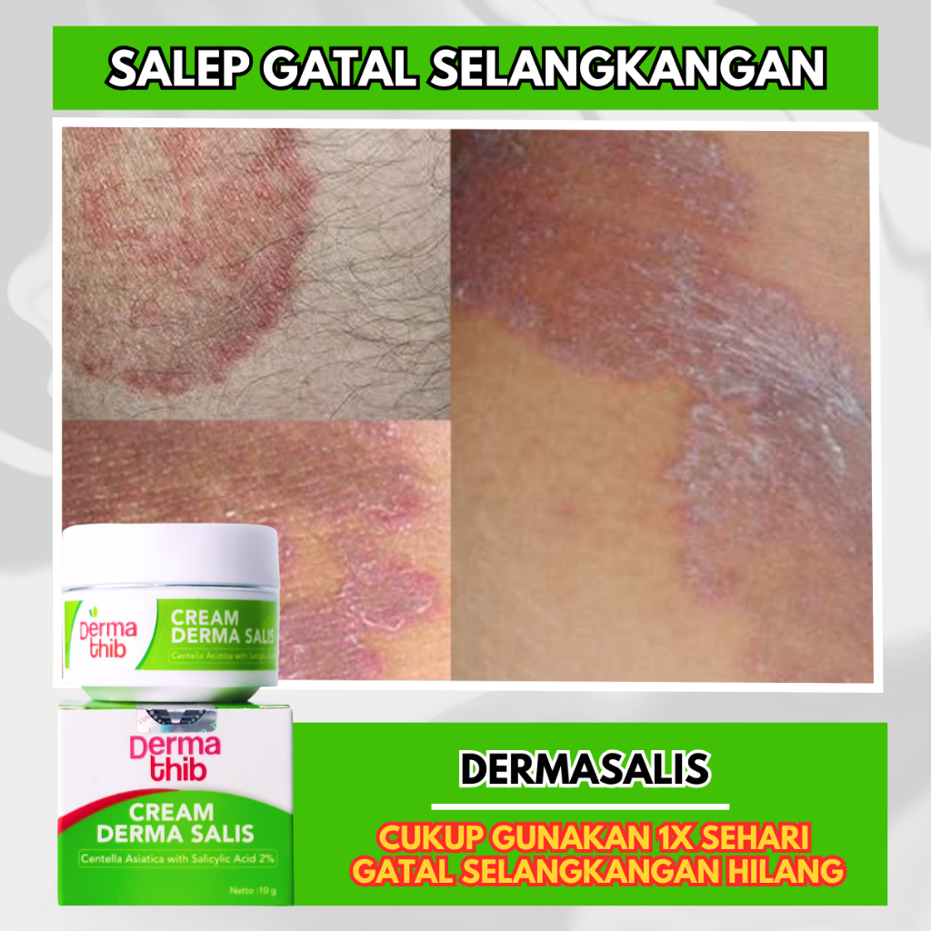 Dermathib Obat Gatal Selangkangan Karena Jamur Pria Dan Wanita | Dermasalis