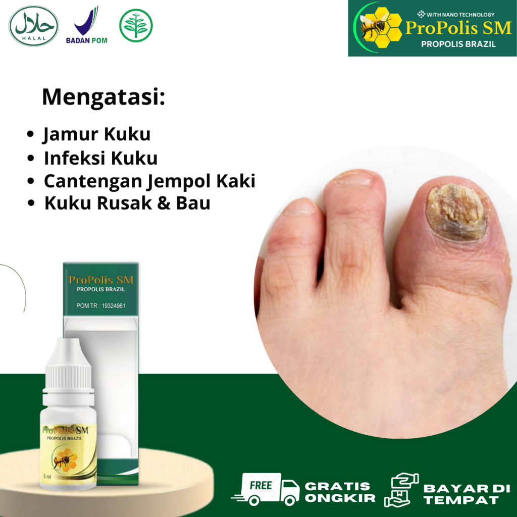 Obat Jamur Kuku Rusak, Infeksi Jamur Kuku, Cantengan Jempol Kaki, Psoriasis Kuku, Vitamin jamur Kuku