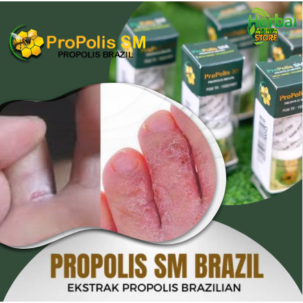 Obat Penghilang Gatel - Gatal & berair di Jari Kaki | Kutu Air - Infeksi Kulit - jamur - tinea pedis