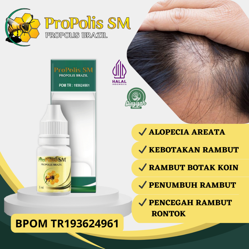 Obat Alopecia Areata, Obat Kulit Kepala Botak, Obat Rambut Botak, Obat Rambut Rontok, Obat Rambut Ro