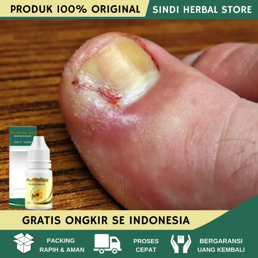 Obat Cantengan Jempol Kaki - Obat Cantengan Tangan - Obat Kuku Cantengan - Obat Cantengan Parah - Ob