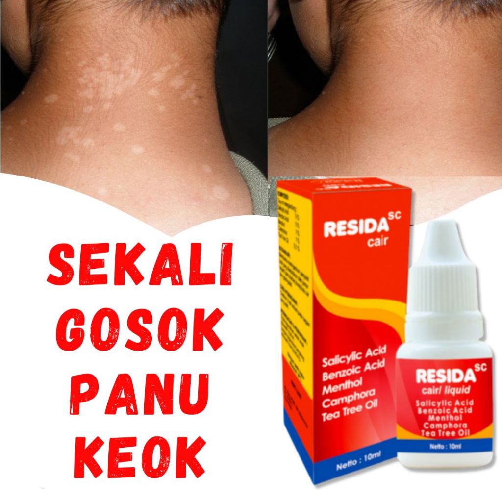 Salep Panu Paling Ampuh 100% Resida Obat Kurap Ori Kadas Kudis Gatal Kulit Original Salap Jamur