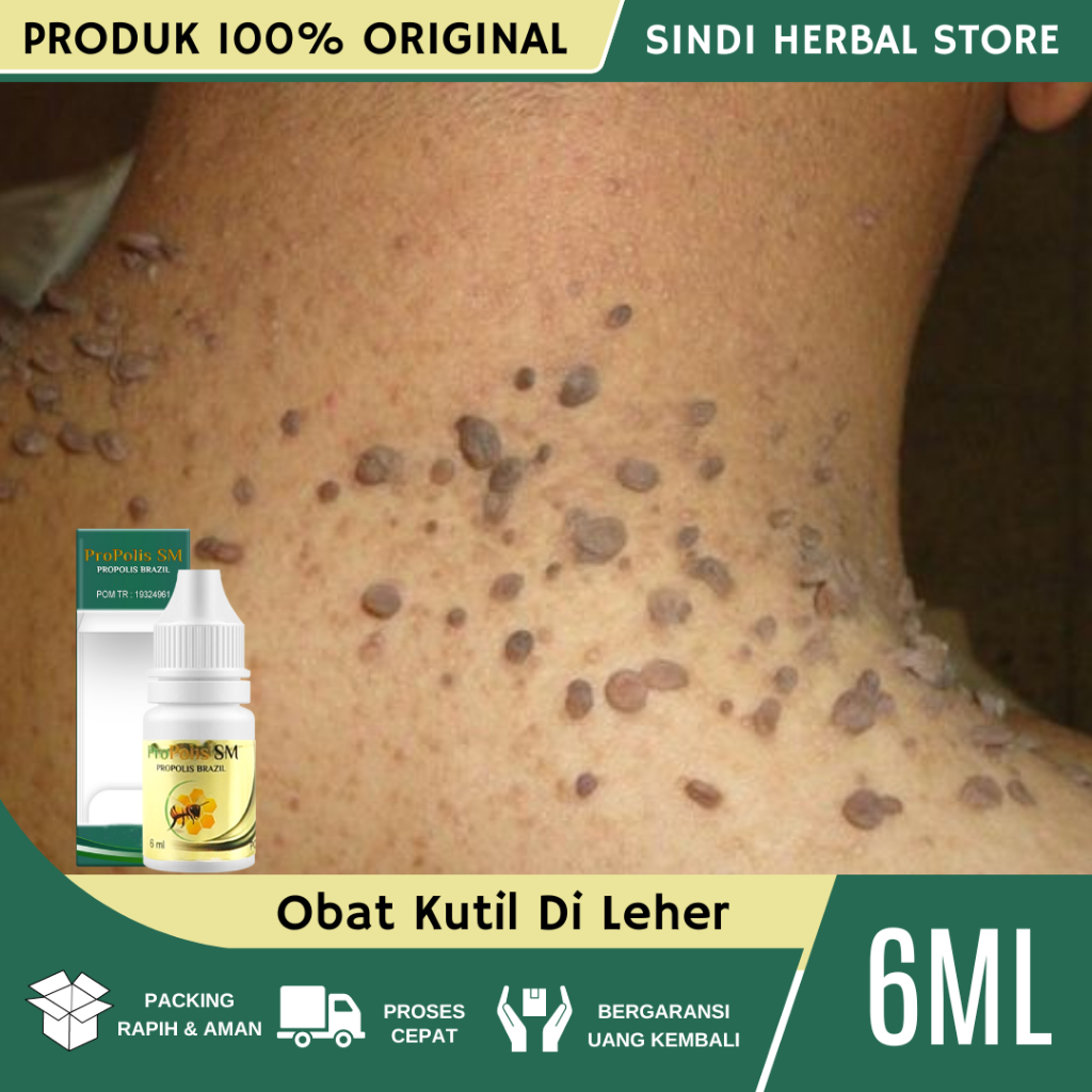 Obat Perontok Kutil Di Leher - Salep Penghilang Kutil - Obat Kutil Di Leher - Obat Kutil Di Ketiak -