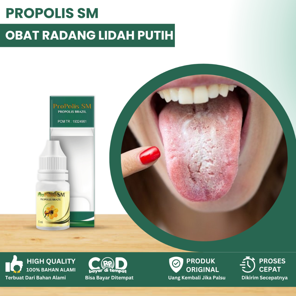 Obat Radang Lidah Putih, Obat Baercak Putih Di Lidah, Obat Lidah Putih Berjamur, Kandidiasis Lidah, 