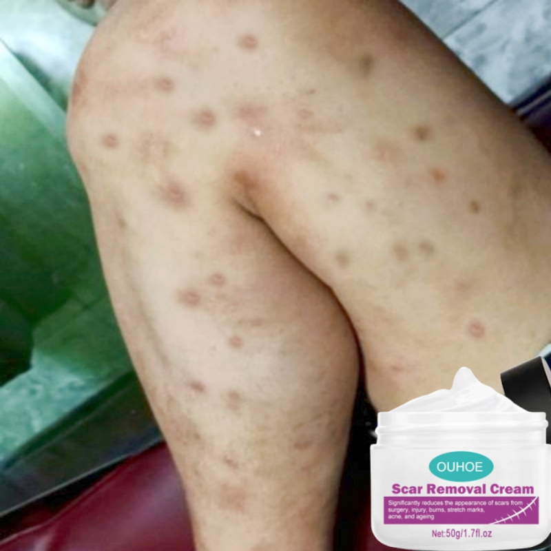 Penghilang bekas luka Penghilang luka koreng bekas gatal gatal Penghilang bekas luka hitam koreng Pe