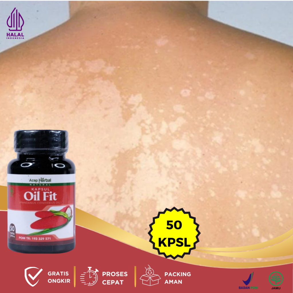 Obat Penghilang Panu, Obat Hapuran Dikulit, Obat Bercak Putih, Obat Balas Bogo, Obat Jamur Kulit, Ob