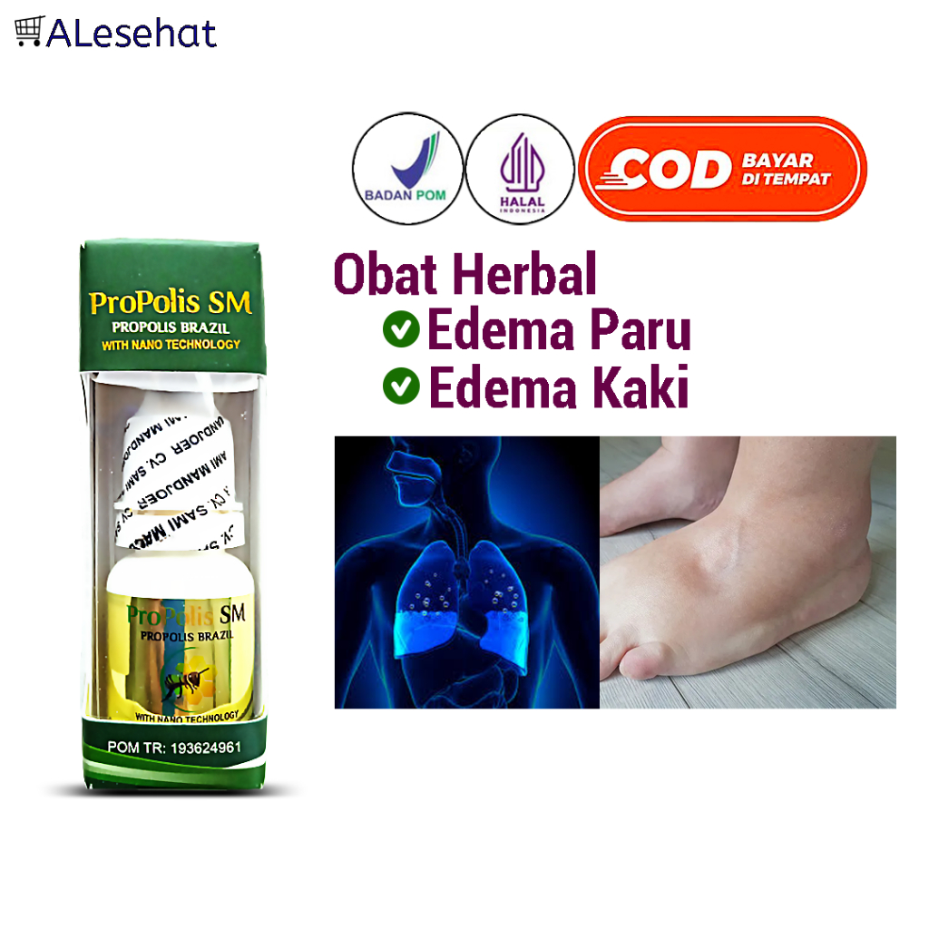 Obat Edema Paru & Kaki Bengkak Herbal Propolis SM