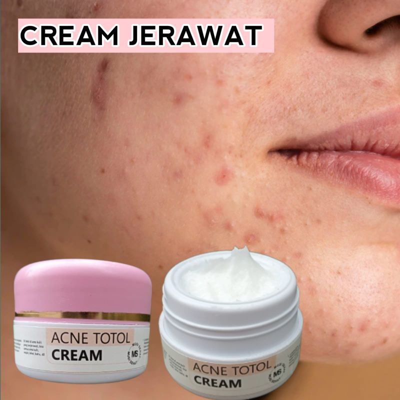 MOISTURIZER SALEP JERAWAT DAN PENGHILANG BEKAS JERAWAT/FLEK HITAM,BRUNTUSAN 100% ORIGINAL!!!
