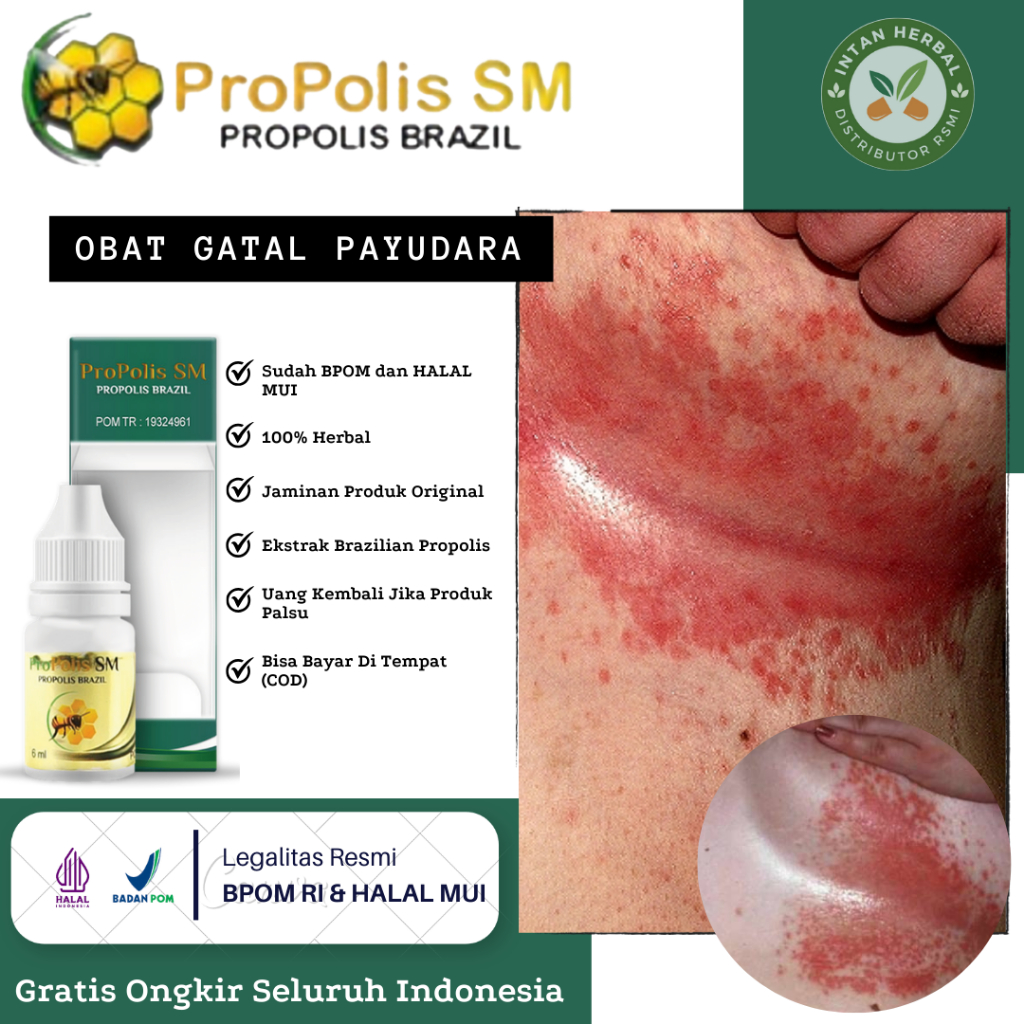Obat Gatal Payudara, Puting Lecet, Gatal Lipatan Payudara, Payudara Bengkak, Benjolan di Payudara, I