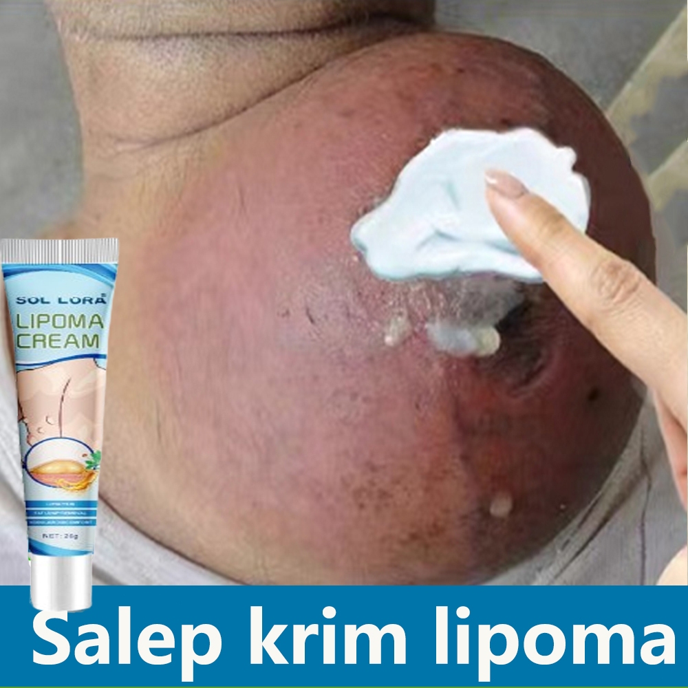 Obat Benjolan Lipoma Salep Lipoma Herbal salep lipoma salep benjolan Benjolan Subkutan Lipoma Remova