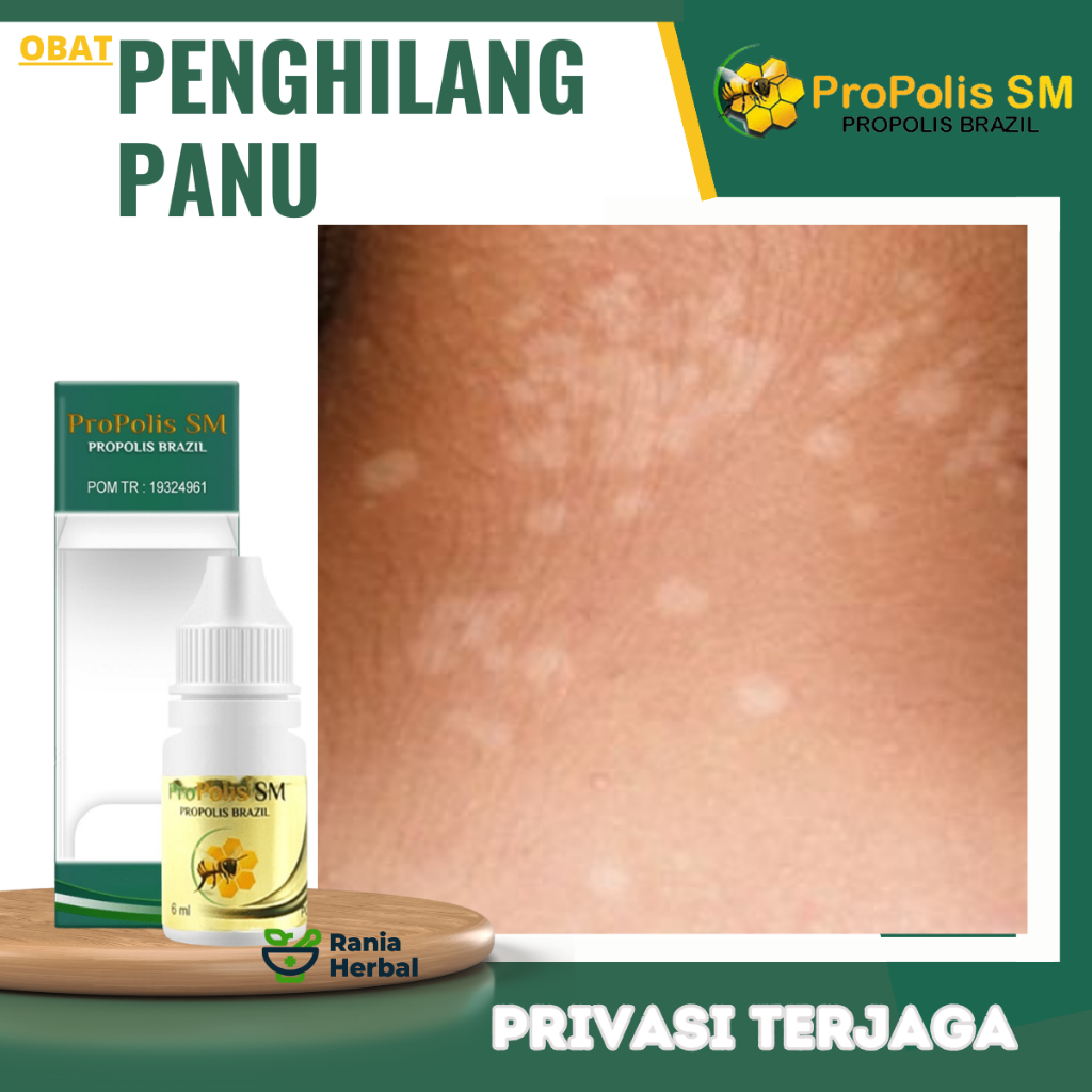 Obat Panu Cair, Obat Penghilang Panu, Obat Hapuran Kulit, Obat Penghilang Panu Di Seluruh Tubuh, Pan