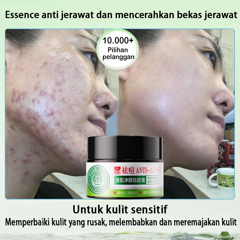 penghilang bekas jerawat hitam menghilangkan bekas jerawat mencerahkan warna kulit 30g cream penghil