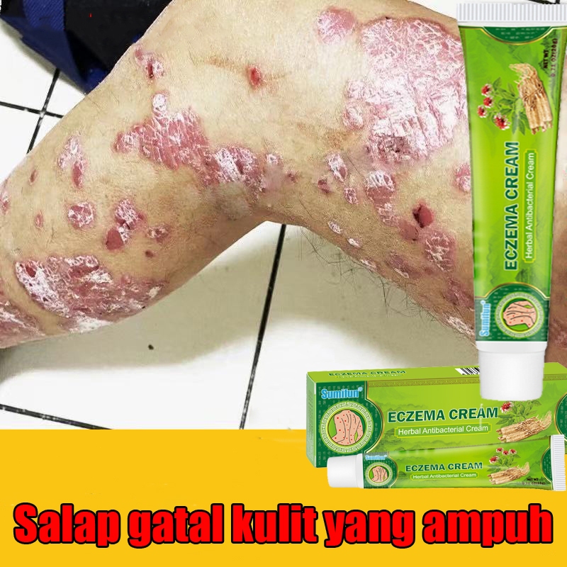 Salep gatal Salep psoriasis Salep Eksim Krim psoriasis paling ampuh Obat psoriasis dan Eksim Menghil