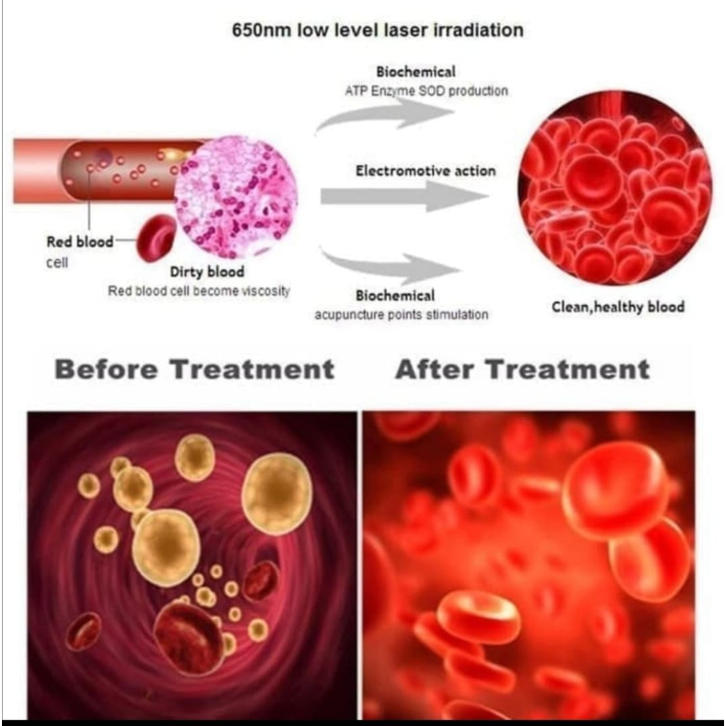 JAM TANGAN TERAPI LASER KESEHATAN UNTUK DIABETES KOLESTEROL