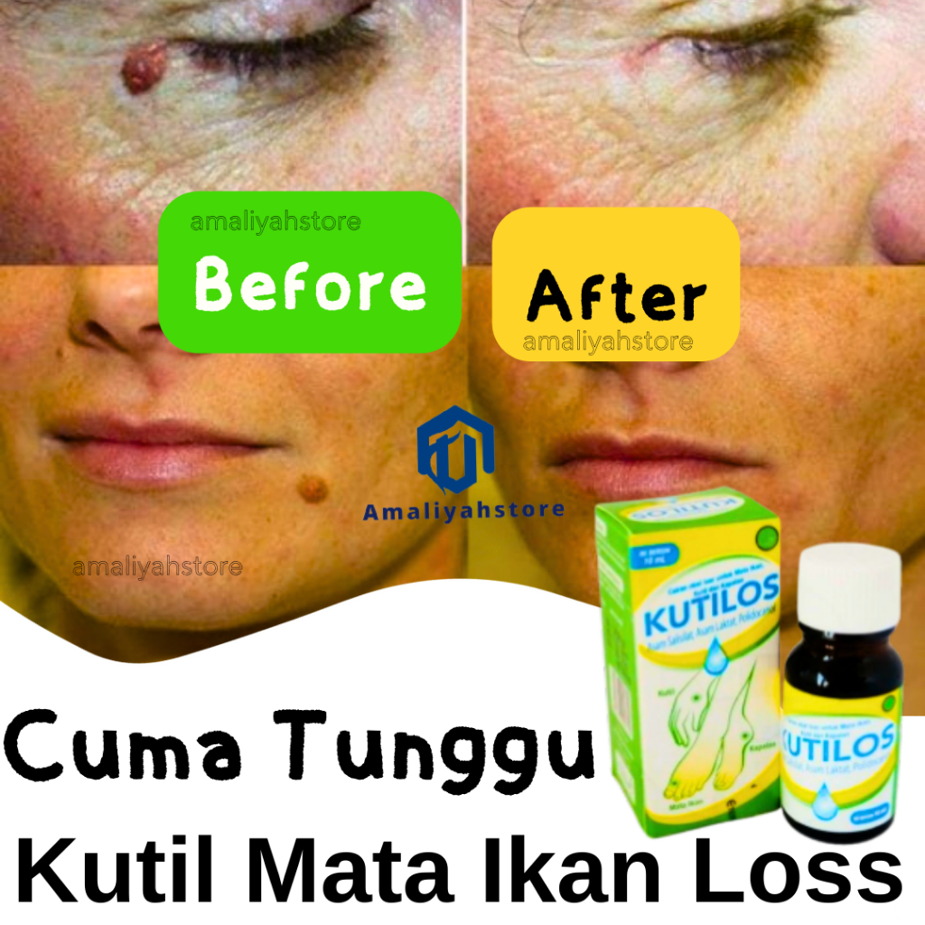 Kutilos Obat Cair Penghilang Kutil Kelamin Mata Ikan Kapalan Untuk Wajah Dan Leher 100% Paling Ampuh