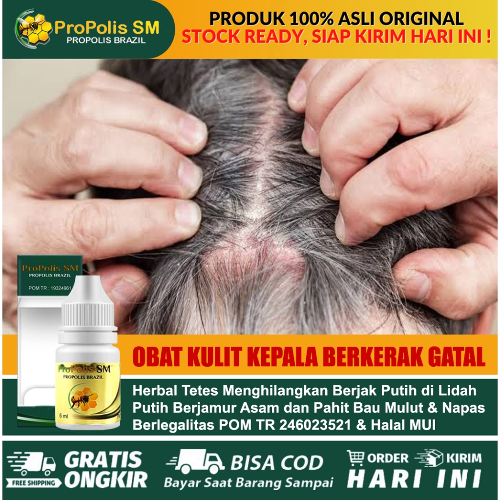 Obat Gatal Kulit Kepala, Kulit Kepala Bekerak Gatal Psoriasis Kulit Kepala, Kulit Kepala Berjamur Dg