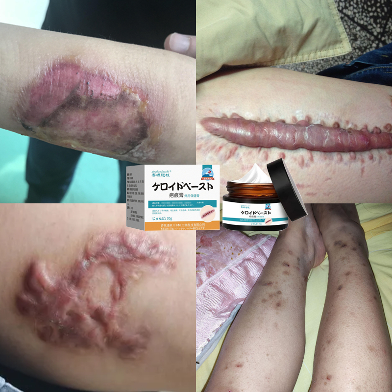 penghilang bekas luka penghilang bekas luka hitam koreng obat keloid penghilang bekas luka bakar pen