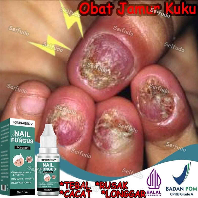 Serum kuku jamur dan rusak obat kuku jamur dan rusak obat jamur kuku 10ML obat kuku rusak paling amp