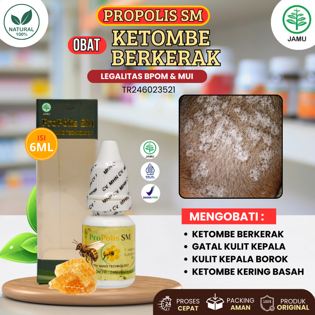 Propolis Sm - Obat Ketombe Berkerak, Obat Gatal Kulit Kepala Kulit Kepala Borok Perih Luka, Ketombe 