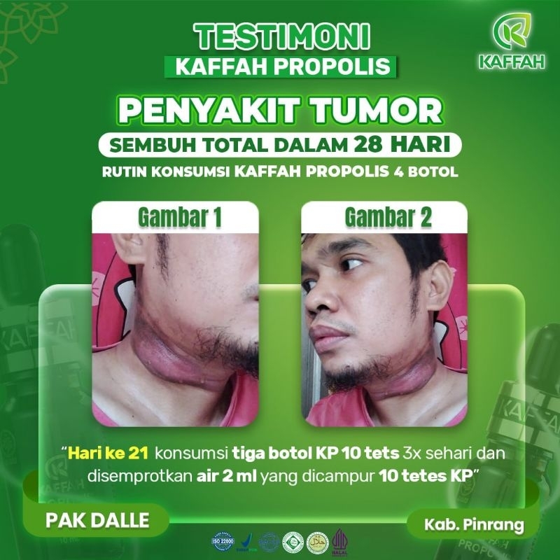 Testimoni kaffah propolis untuk tumor